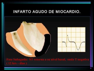 INFARTO AGUDO DE MIOCARDIO.
Fase Subaguda: ST retorna a su nivel basal, onda T negativa
( 12 hrs – dias )
 