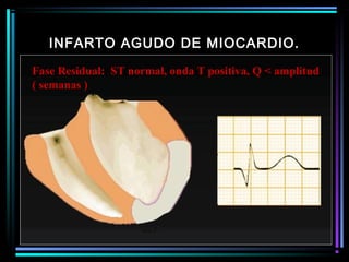INFARTO AGUDO DE MIOCARDIO.
Fase Residual: ST normal, onda T positiva, Q < amplitud
( semanas )
 