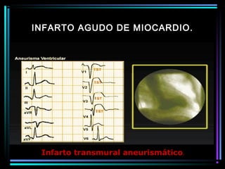 INFARTO AGUDO DE MIOCARDIO.
Infarto transmural aneurismático.
 