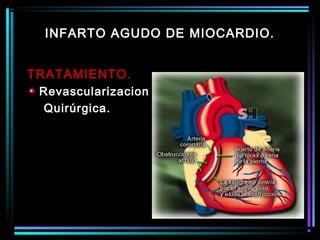 TRATAMIENTO.
Revascularizacion
Quirúrgica.
INFARTO AGUDO DE MIOCARDIO.
 
