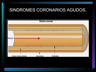 SINDROMES CORONARIOS AGUDOS.
 