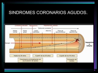 SINDROMES CORONARIOS AGUDOS.
 