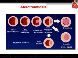 Aterotrombosis.
Placa
aterosclerótica
Fisura
ruptura
de la placa
Formación
del trombo
Trombo
incorporado
dentro
del ateroma
Placa
estable Oclusión
Evento agudo
Embolismo
Isquemia crónica
 