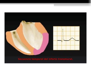 Secuencia temporal del infarto transmural.
 