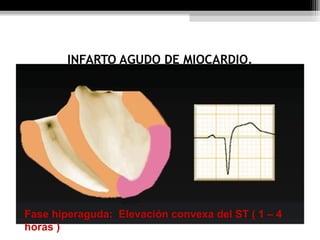 INFARTO AGUDO DE MIOCARDIO.
Fase hiperaguda: Elevación convexa del ST ( 1 – 4
horas )
 