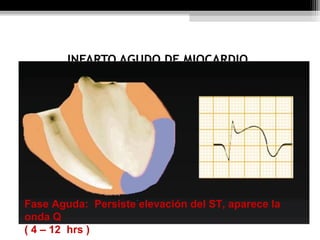 INFARTO AGUDO DE MIOCARDIO.
Fase Aguda: Persiste elevación del ST, aparece la
onda Q
( 4 – 12 hrs )
 
