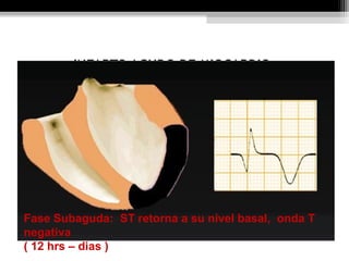 INFARTO AGUDO DE MIOCARDIO.
Fase Subaguda: ST retorna a su nivel basal, onda T
negativa
( 12 hrs – dias )
 