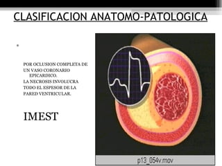 CLASIFICACION ANATOMO-PATOLOGICA
• INFARTO
TRANSMURAL:
POR OCLUSION COMPLETA DE
UN VASO CORONARIO
EPICARDICO.
LA NECROSIS INVOLUCRA
TODO EL ESPESOR DE LA
PARED VENTRICULAR.
IMEST
 