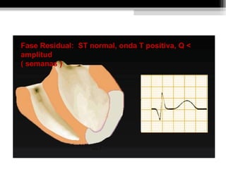 INFARTO AGUDO DE MIOCARDIO.Fase Residual: ST normal, onda T positiva, Q <
amplitud
( semanas )
 