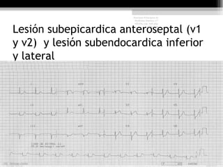 Lesión subepicardica anteroseptal (v1
y v2) y lesión subendocardica inferior
y lateral
Harrison Principios de
Medicina Interna, 17°
edición, cap. 226 pág.
1586-1594
 