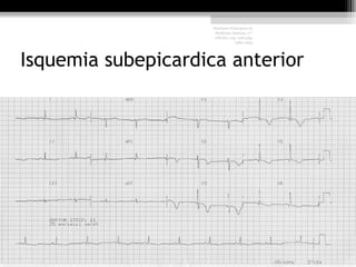 Isquemia subepicardica anterior
Harrison Principios de
Medicina Interna, 17°
edición, cap. 226 pág.
1586-1594
 