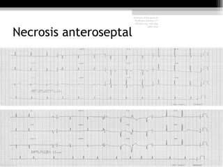 Necrosis anteroseptal
Harrison Principios de
Medicina Interna, 17°
edición, cap. 226 pág.
1586-1594
 