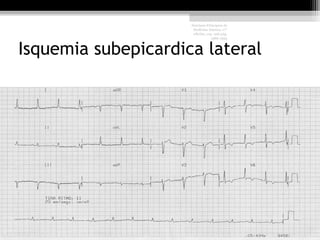 Isquemia subepicardica lateral
Harrison Principios de
Medicina Interna, 17°
edición, cap. 226 pág.
1586-1594
 