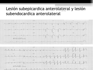 Lesión subepicardica anterolateral y lesión
subendocardica anterolateral
Harrison Principios de
Medicina Interna, 17°
edición, cap. 226 pág.
1586-1594
 