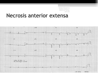 Necrosis anterior extensa
Harrison Principios de
Medicina Interna, 17°
edición, cap. 226 pág.
1586-1594
 
