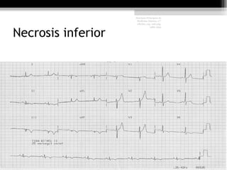 Necrosis inferior
Harrison Principios de
Medicina Interna, 17°
edición, cap. 226 pág.
1586-1594
 