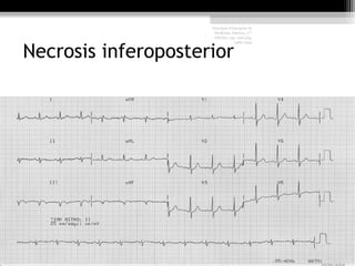 Necrosis inferoposterior
Harrison Principios de
Medicina Interna, 17°
edición, cap. 226 pág.
1586-1594
 