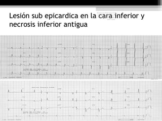 Lesión sub epicardica en la cara inferior y
necrosis inferior antigua
Harrison Principios de
Medicina Interna, 17°
edición, cap. 226 pág.
1586-1594
 