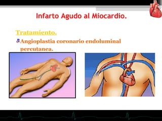 Tratamiento.
Angioplastia coronario endoluminal
percutanea.
Infarto Agudo al Miocardio.
 