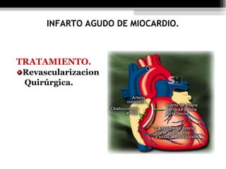 TRATAMIENTO.
Revascularizacion
Quirúrgica.
INFARTO AGUDO DE MIOCARDIO.
 