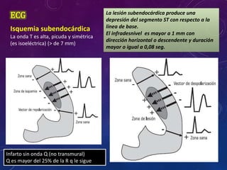 ECG
Isquemia subendocárdica
La onda T es alta, picuda y simétrica
(es isoeléctrica) (> de 7 mm)
La lesión subendocárdica produce una
depresión del segmento ST con respecto a la
línea de base.
El infradesnivel es mayor a 1 mm con
dirección horizontal o descendente y duración
mayor o igual a 0,08 seg.
Infarto sin onda Q (no transmural)
Q es mayor del 25% de la R q le sigue
 