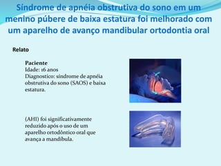 Relato
Paciente
Idade: 16 anos
Diagnostico: síndrome de apnéia
obstrutiva do sono (SAOS) e baixa
estatura.
(AHI) foi significativamente
reduzido após o uso de um
aparelho ortodôntico oral que
avança a mandíbula.
Síndrome de apnéia obstrutiva do sono em um
menino púbere de baixa estatura foi melhorado com
um aparelho de avanço mandibular ortodontia oral
 