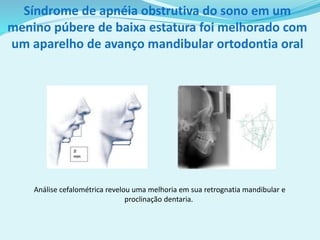 Análise cefalométrica revelou uma melhoria em sua retrognatia mandibular e
proclinação dentaria.
Síndrome de apnéia obstrutiva do sono em um
menino púbere de baixa estatura foi melhorado com
um aparelho de avanço mandibular ortodontia oral
 