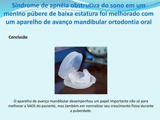 Conclusão
O aparelho de avanço mandibular desempenhou um papel importante não só para
melhorar a SAOS do paciente, mas também em normalizar seu crescimento físico durante
a puberdade.
Síndrome de apnéia obstrutiva do sono em um
menino púbere de baixa estatura foi melhorado com
um aparelho de avanço mandibular ortodontia oral
 