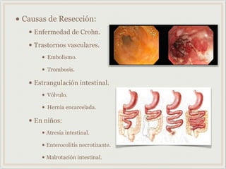 • Causas de Resección:
• Enfermedad de Crohn.
• Trastornos vasculares.
• Embolismo.
• Trombosis.
• Estrangulación intestinal.
• Vólvulo.
• Hernia encarcelada.
• En niños:
• Atresia intestinal.
• Enterocolitis necrotizante.
• Malrotación intestinal.
 
