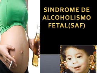 SINDROME DE ALCOHOLISMO FETAL(SAF) 