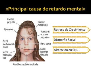 «Principal causa de retardo mental»
