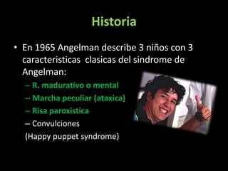 Sindrome de angelman | PPTX