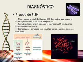 Sindrome de Angelman | PPTX