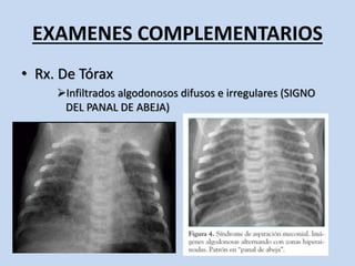 Sindrome De Aspiracion Meconial PPTX