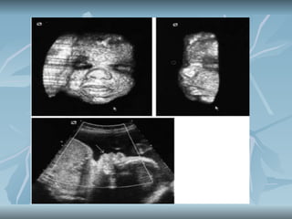 Sindrome de beckwith wiedeman- | PPT