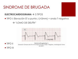 ELECTROCARDIOGRAMA  3 TIPOS
 TIPO I: Elevación ST o punto J (>2mm) + onda T negativa
 “LOMO DE DELFÍN”
 TIPO II
 TIPO III
SINDROME DE BRUGADA
 