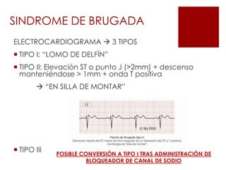 ELECTROCARDIOGRAMA  3 TIPOS
 TIPO I: “LOMO DE DELFÍN”
 TIPO II: Elevación ST o punto J (>2mm) + descenso
manteniéndose > 1mm + onda T positiva
 “EN SILLA DE MONTAR”
 TIPO III
SINDROME DE BRUGADA
POSIBLE CONVERSIÓN A TIPO I TRAS ADMINISTRACIÓN DE
BLOQUEADOR DE CANAL DE SODIO
 