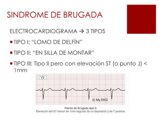 ELECTROCARDIOGRAMA  3 TIPOS
 TIPO I: “LOMO DE DELFÍN”
 TIPO II: “EN SILLA DE MONTAR”
 TIPO III: Tipo II pero con elevación ST (o punto J) <
1mm
SINDROME DE BRUGADA
 