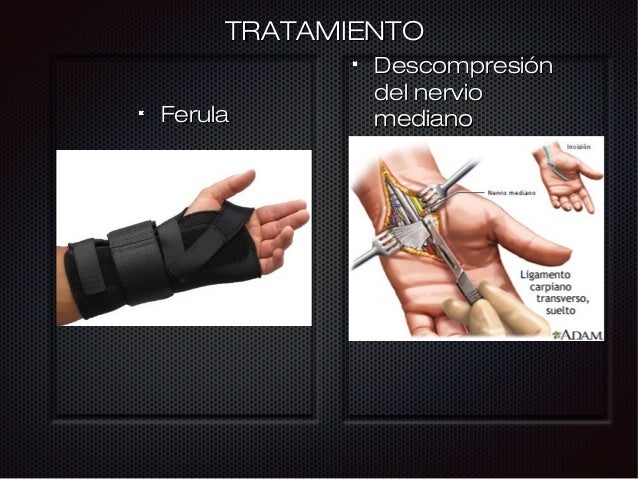 Sindrome de compresion nerviosa del miembro superior