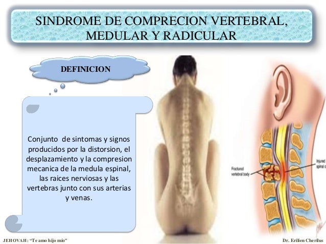 Resultado de imagen para El sÃ­ndrome radicul