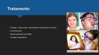Tratamento
 Cirurgia - para evitar o fechamento de suturas do crânio ;
 A craniotomia;
 Descompressão de órbita;
 Cirurgia ortognática;
 
