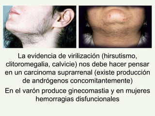 La evidencia de virilización (hirsutismo,
clitoromegalia, calvicie) nos debe hacer pensar
en un carcinoma suprarrenal (existe producción
de andrógenos concomitantemente)
En el varón produce ginecomastia y en mujeres
hemorragias disfuncionales
 