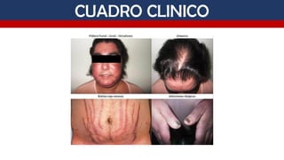 Comprehensive Overview of Cushing Syndrome: Diagnosis and Treatment in ...