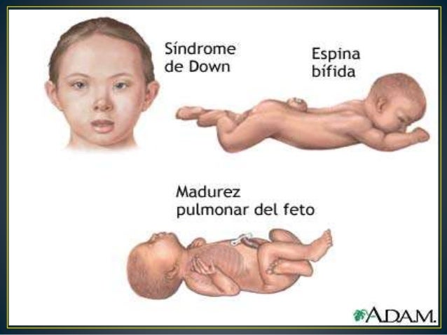 ¿Sería etico pagar a las madres para que aborten fetos con cromosomas defectuosos? Sindrome-de-dawn-9-638