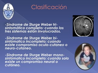 Angiomatosis Meníngea Capilar