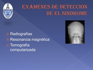AngiomatosisEncefalofacial
