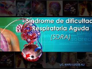 Síndrome de dificultadSíndrome de dificultad
Respiratoria AgudaRespiratoria Aguda
(SDRA)(SDRA)
 