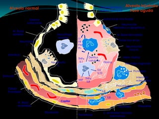 Alveolo injuriadoFase agudaAlveolo normal Desprendimiento epitelio bronquialSurfactante inactivadoSistemasurfactanteNeumocitoINecrótico o apoptóticoM. Basal epitelialMacrófago alveolarM. Basal denudadaLtFRPAFPr-Fluído rico en pr-NeumocitoINeumocitoIIintactoIntersticio DetrituscelularesMem. hialinaTNFIL1Fibrina NeumocitoIINeutrófilo migrandoIL6IL10Proteasas Eritrocito Intersticio edematosoTNFIL8MIFProcolágeno CélulaEndotelial IL8IL8Capilar M. Basal endotelialPlaquetas Neutrófilo Fibroblasto C. endotelial injuriadaedematosaFibroblasto 