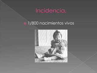 Incidencia.1/800 nacimientos vivos