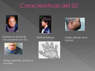 Características del SDApariencia facial de una paciente con SD.Perfil achatado.Orejas debajo de lo normal.Lengua grande, protusa y surcada.